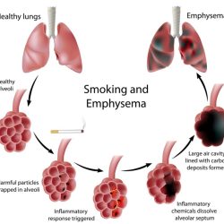 Copd bronchitis bpco lung emphysema obstructive alveoli asthma lungs inflammation pulmonary structure emphysème respiratory symptoms poumon cure occur